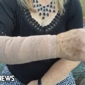 Fangs, feathers and talons: Snake & hawk attack Texas woman