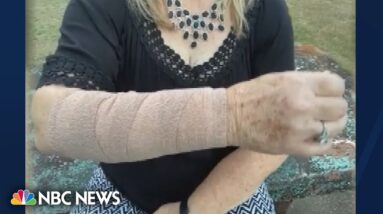 Fangs, feathers and talons: Snake & hawk attack Texas woman